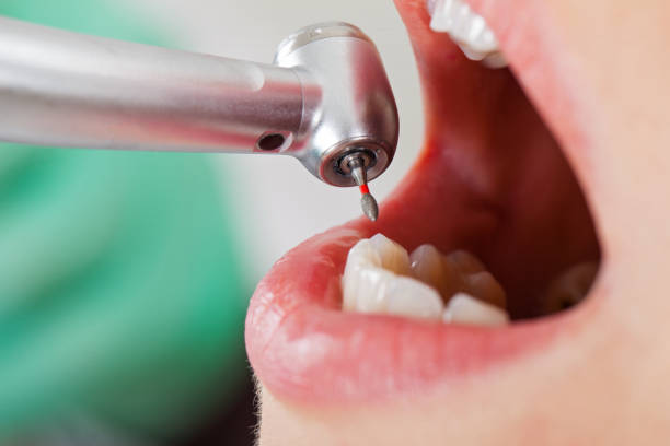Best Broken or Chipped Tooth Repair in Nooksack, WA